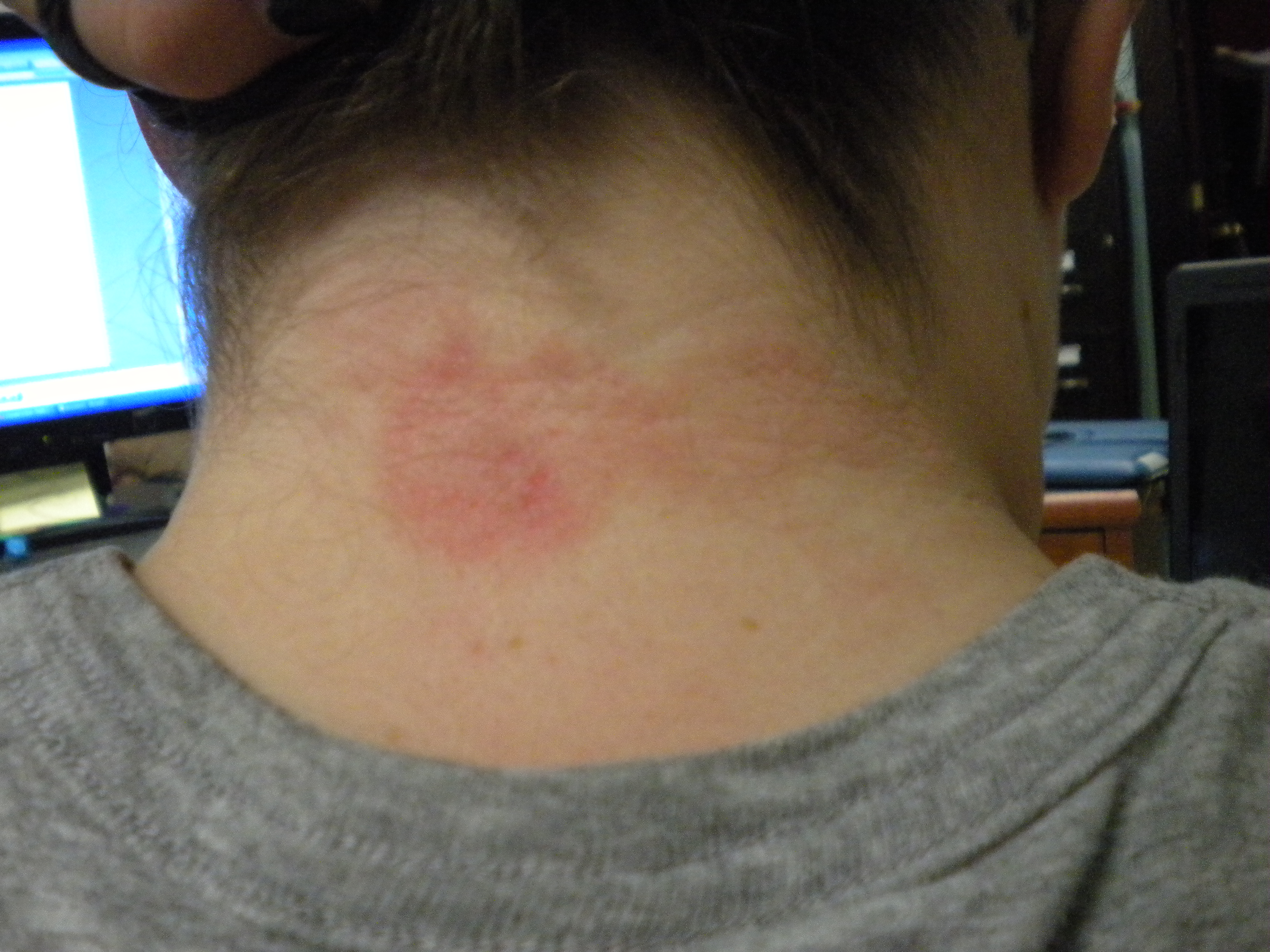 rash on neck and back #10
